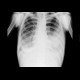 Pleural effusion, loculated: X-ray - Plain radiograph